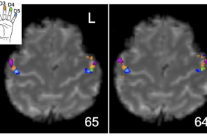 brain images following nerve injury